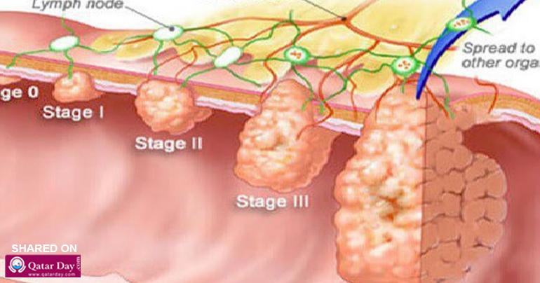 The Cancer Dies When You Eat These Five Foods, It's Time To Start Eating Them