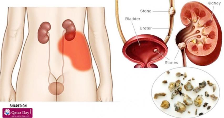 You Need A Kidney Cleanse. Here’s How To Flush Out Toxins From Your Kidneys

