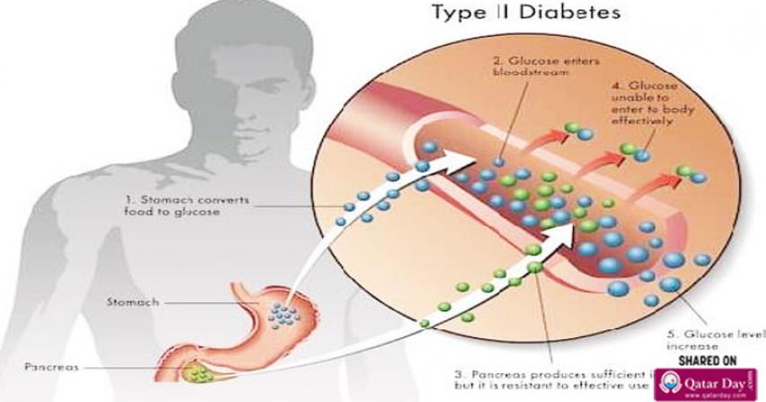 Diabetes mellitus type 2 – Symptoms, causes and treatment