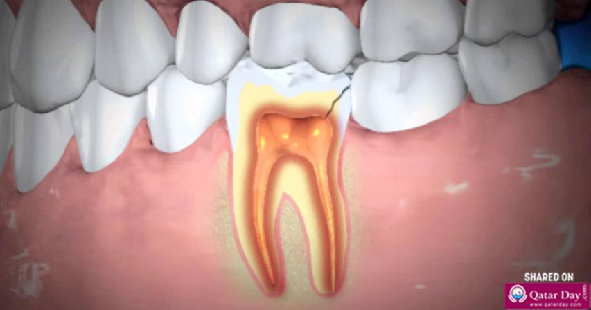 Abscessed Teeth