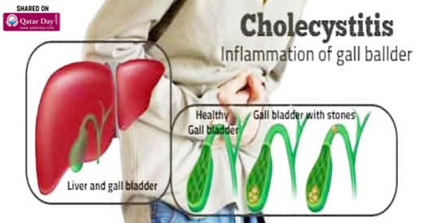 Cholecystitis and Back Pain 