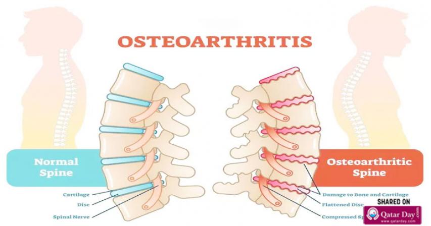 
Brief History of Osteoarthritis and Back Pain 
