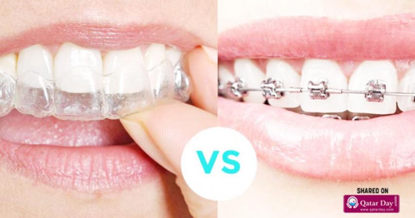 Comparison of Braces and Invisalign Aligners Orthodontic Treatments
