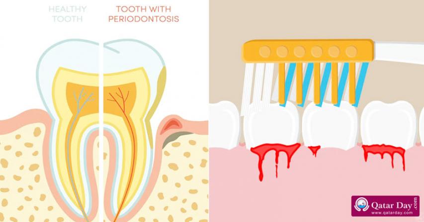 Dentist Explains 10 Ways to Treat Bleeding Gums