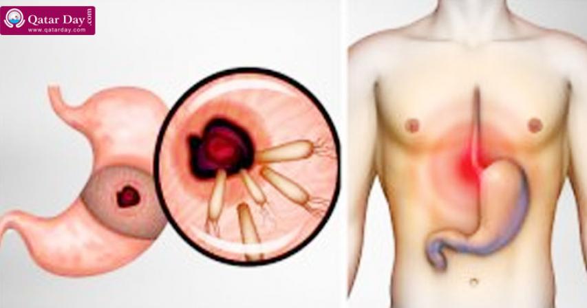 Here is How to Kill the Bacteria that Causes Heartburn and Bloating
