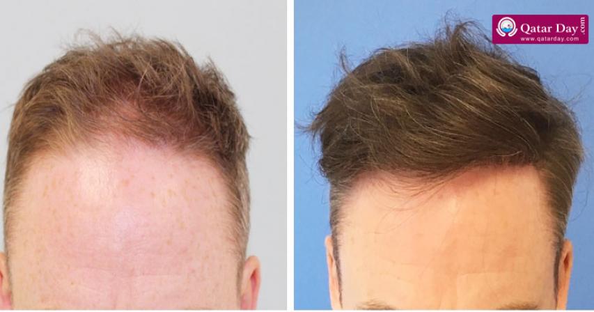 Hair transplant options in the UK