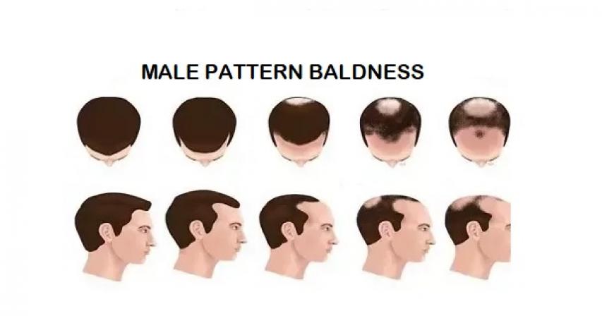 Effectiveness Of Using Finasteride For Male Pattern Baldness(560)