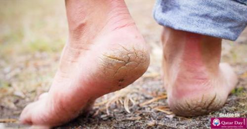 7 Possible Causes Of Cracked Heels
