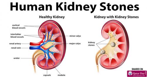 7 Ways to Prevent Kidney Stones