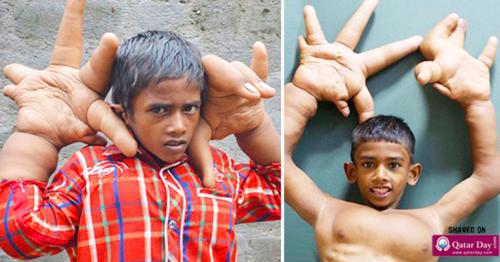 Born Different - Mystery Condition Gives Indian Boy Gigantic Hands