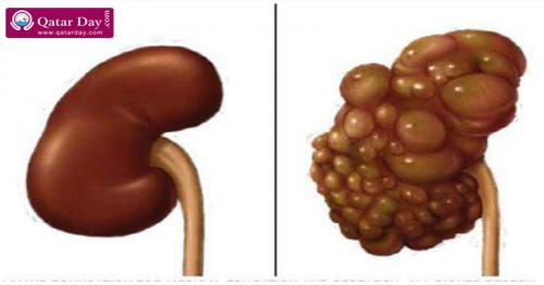health,kidney