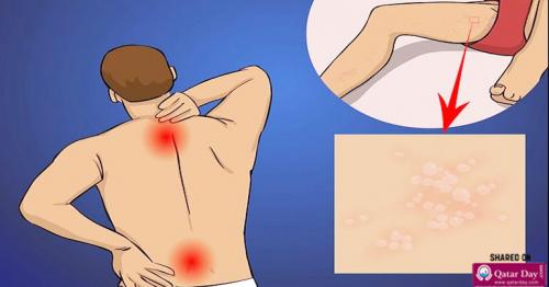 Back Pain and Herpes Simplex 