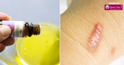 12 Best Essential Oils For Healing Scars
