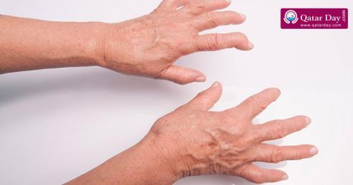 Home Remedies for Rheumatoid Arthritis
