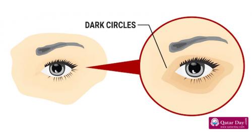  5 Easy Ways to Remove Dark Circles Under Eyes Naturally
