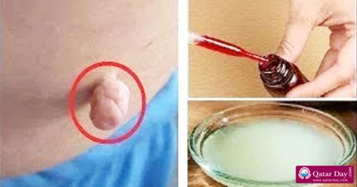 7 easy and homemade ways to remove skin tags without going to a doctor
