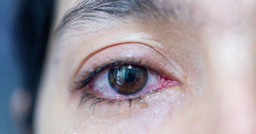 Coronavirus can stay in a patient’s eyes long after it leaves their nose 