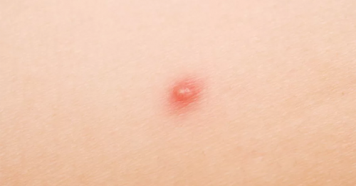Causes of Little Red Dots on Skin- Things You Need To Know
