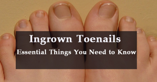 Essential Things You Need to Know About Ingrown Toenails