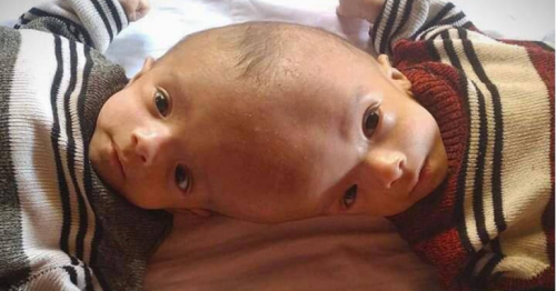 King Salman orders transfer of Yemeni conjoined twins for medical examination