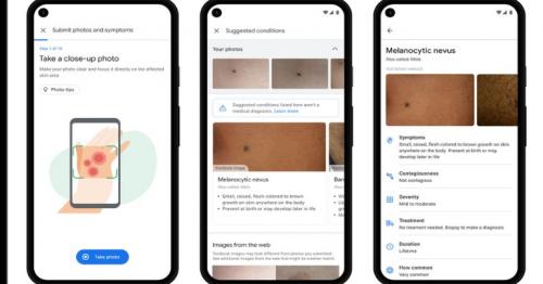 Google AI tool can help patients identify skin conditions